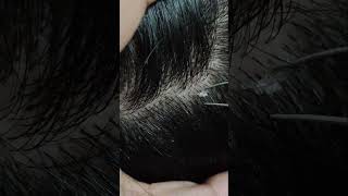 Relaxing dandruff removal | visual ASMR to relax your mind