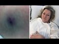 Mother Talks About Surviving Funnel Web Spider Bite