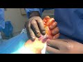 squeezing pus out of a foot