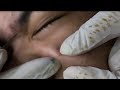 How To Remove Blackheads And Whiteheads On Face Easy #09 ✦ Dr Laelia ✦