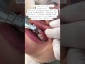 passo a passo de remoção de resina composta antiga dentista dentes facetas