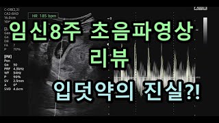 임산부 입덧약 | 8주된 태아 크기는? | 임신8주차 태아의 움직임 | 8주차 초음파영상 리뷰