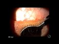 Meibomian gland expression EXPLAINED