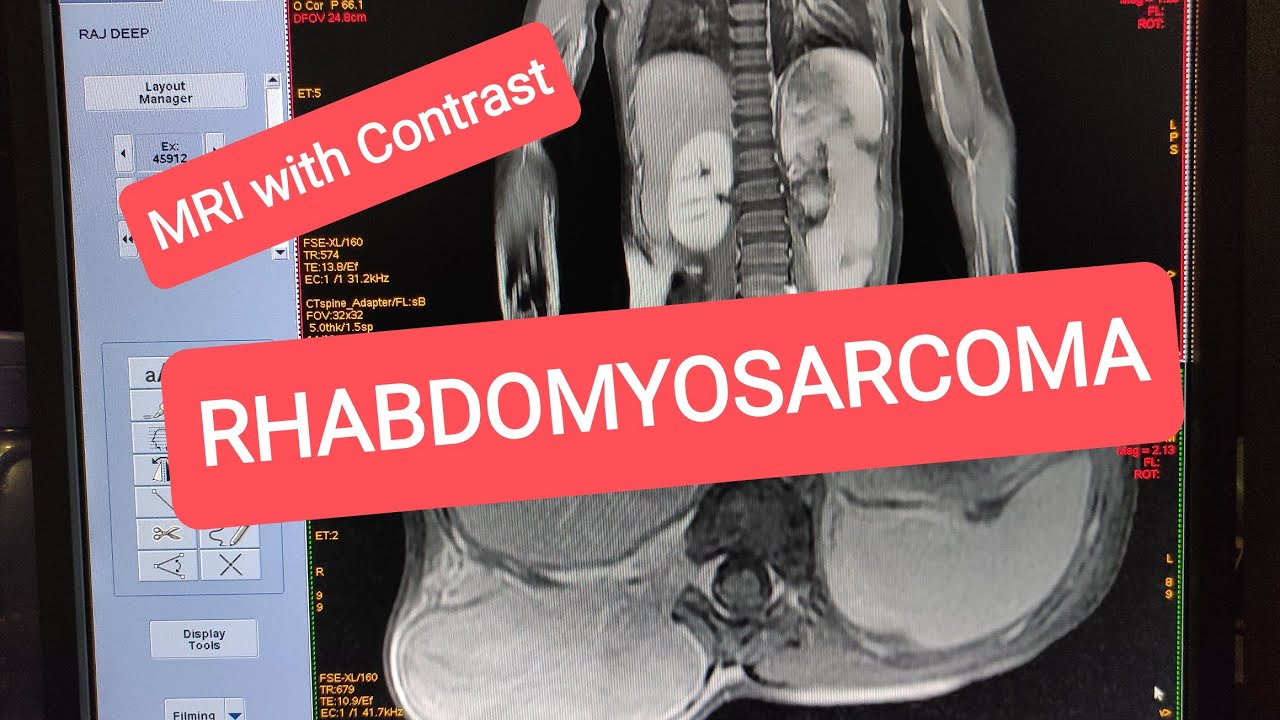 Rhabdomyosarcoma, MRI with Contrast.