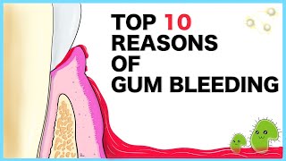 Gum Bleeding: Top 10 causes