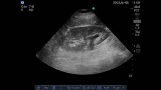 Dilatation pyélocalicielle Échographie