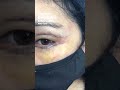 UPPER BLEPHAROPLASTY INCISION‼️ #upperblepharoplasty  #blepharoplasty #scars #viral #plasticsurgery