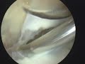 The Role of Complete Suprapatellar Plicae