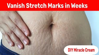 Say Goodbye to Stretch Marks