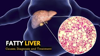 Fatty Liver, Causes, Signs and Symptoms, Diagnosis and Treatment.