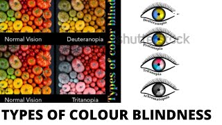 TYPES OF COLOUR BLINDNESS - PROTANOPIA, TRITANOPIA, DEUTERANOPIA