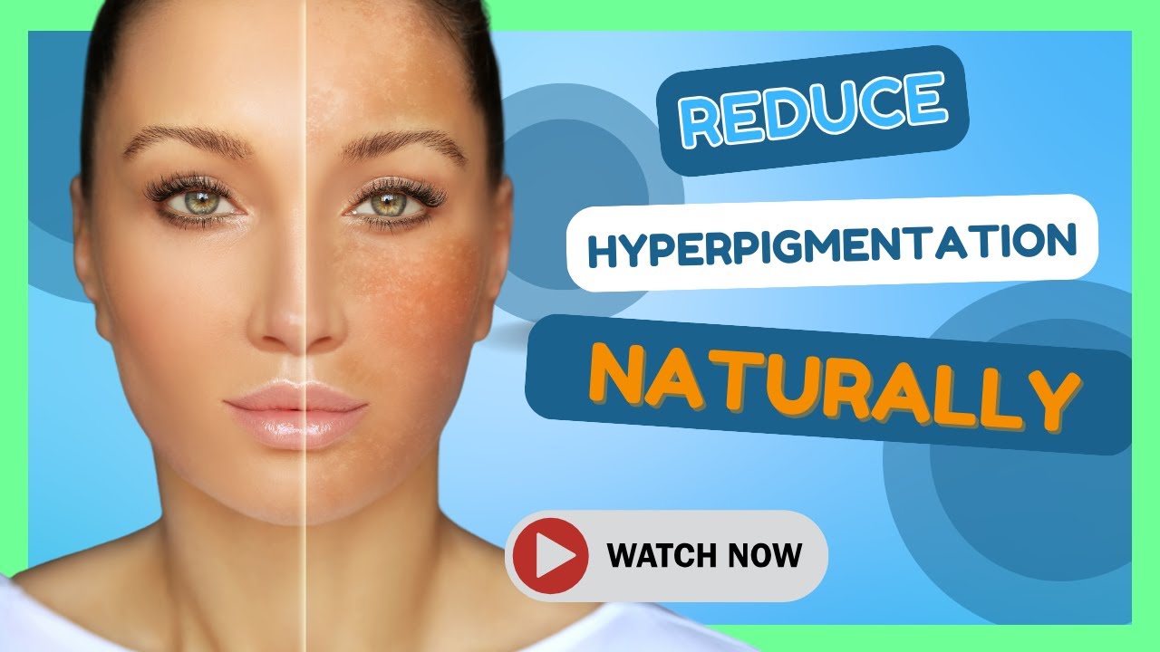 How To Reduce Hyperpigmentation Naturally Youtube