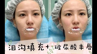 【医美vlog】一天注射了两针玻尿酸？丰唇真的很痛！医美清单大公开