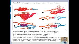 Видеодоклад: Врожденная артерио-венозная мальформация головного мозга