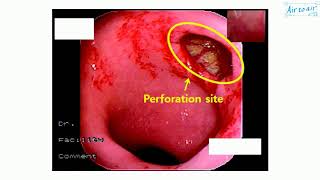 gastrointestinal perforation