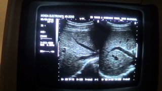 ultrasound portal vs hepatic veins for begenners