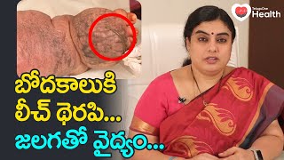 Elephantiasis (Bodha Kalu) | బోదకాలుకి జలగతో వైద్యం..! Unani Dr. SGV Sathya | TeluguOne Health