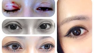 ♛[QQ整型經]♥ 我的雙眼皮整容分享♥ My Double Eyelid Surgery