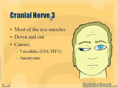 Third Nerve Palsy – FREE Third Nerve Palsy Information | Encyclopedia ...