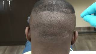 FUE Scar FUE Hair Transplant Surgery Scars 3 Months Follow Up Follicular Unit Extraction Dr. Diep