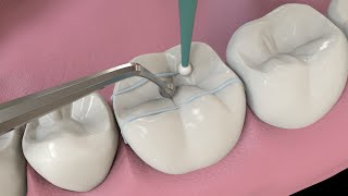 Dental Treatment | medical animation | sample use only by Dandelion Team