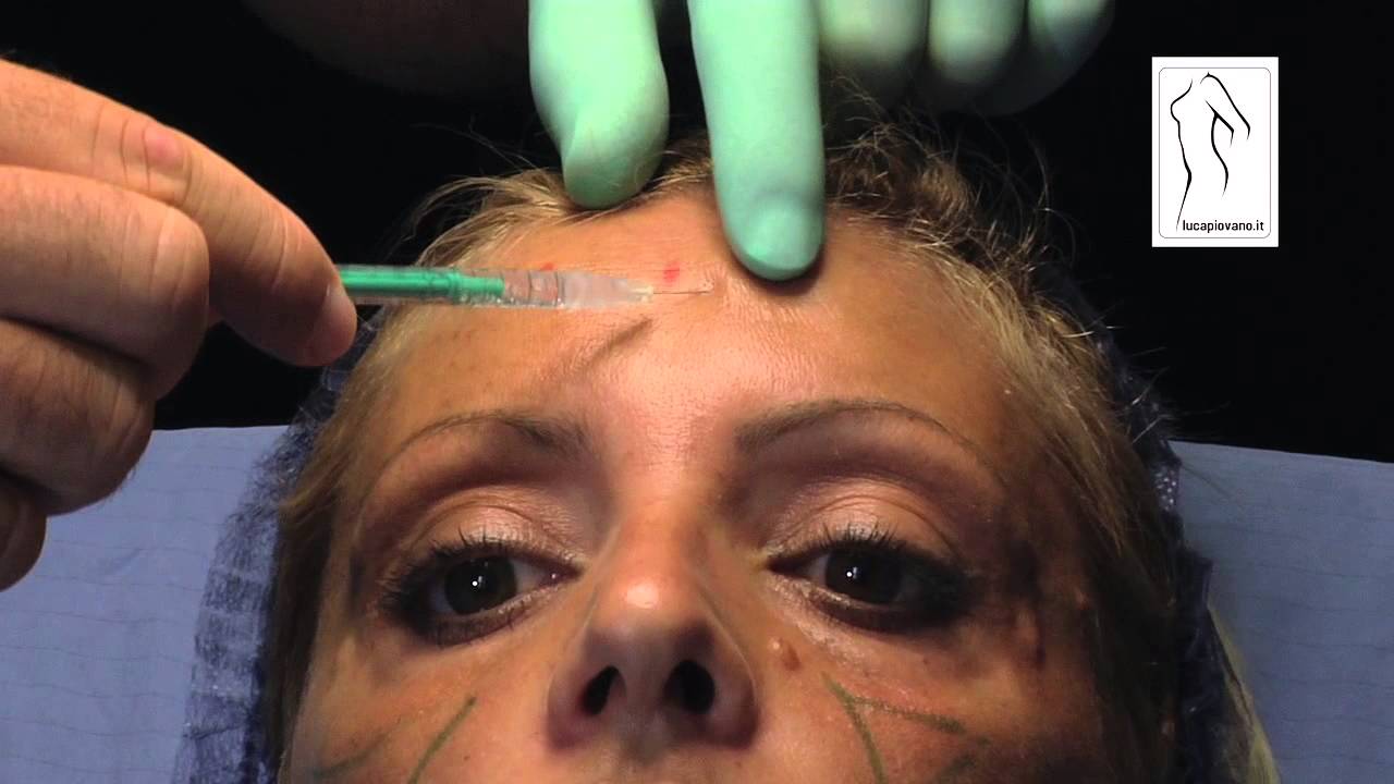 Botox Injection Technique For Wrinkles Italy Youtube