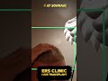 4 ay sonrasi 6000 greft saÇ ekİmİ sonucu ers clİnİc hairtransplant sacekimi