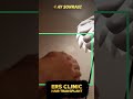 4 ay sonrasi 6000 greft saÇ ekİmİ sonucu ers clİnİc hairtransplant sacekimi