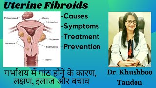 Uterine Fibroids Causes, Symptoms and Treatment | गर्भाशय में गांठ होने के कारण, लक्षण और इलाज |