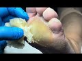 thick calluses on the soles of my feet like plastic【pedicure master lin jun】