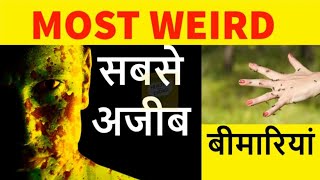 दुनिया के सबसे अजीब बीमारी || world's weirdest disease || #trending #facts #21