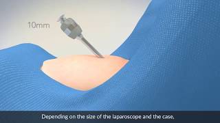 Abdominal entry In laparoscopic gynecologic surgery