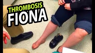 Fiona's Phlebitis and Thrombosis Redux