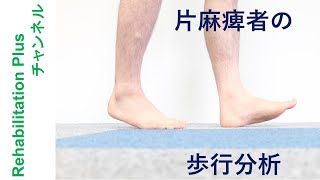 片麻痺者の歩行分析