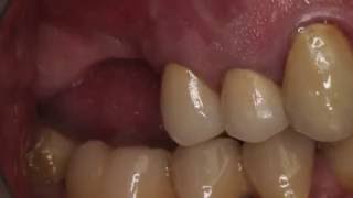 Cavid Ahmedbeyli | Dental implant placement with simultaneous sinus floor augmentation.