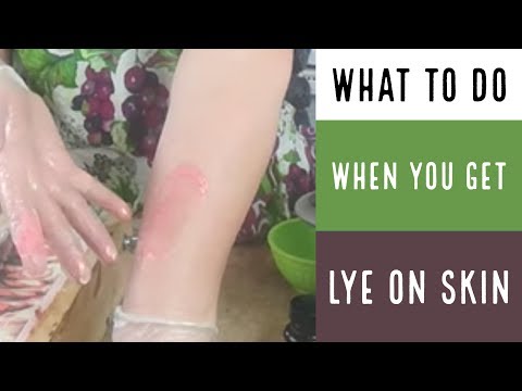 What To Do when You get Lye On Your Skin / How to Make Soap What To Do when You get Lye On Your Skin / How to Make Soap
