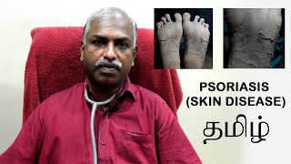 Palmoplantar Psoriasis | Psoriasis on feet - Dr. Selvin Innocent Dhas | Tamil