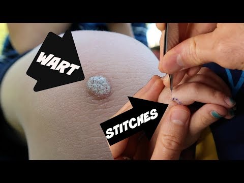 Getting rid of WARTS. Getting rid of WARTS.
