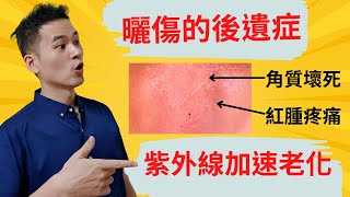 2023醫學美容，紫外線如何傷害皮膚? 造成哪些後遺症? 防曬SPF 是甚麼，化學防曬、物理防曬 實際比較