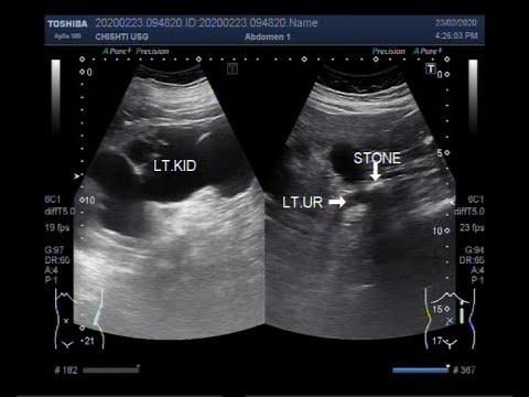 Ultrasound Video Showing What A Ureteral Stone Can Result In If It ...