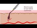 Electrolysis for hair removal