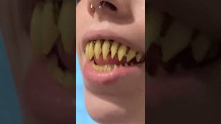 Why Is This FRIGHTENING Tooth Trend Is Taking Over!? 🧛🦷