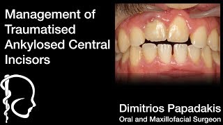 Guided Implant Surgery - Management of Traumatised Ankylosed Central Incisors