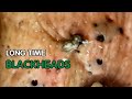 Blackheads Removal, Acne Hidden For a Long Time