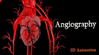 Angiography - Complete visual guide ( 3D Animation )