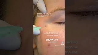 How to Safely \u0026 Effectively Use Botox for Brow Lift