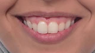 Non Surgical Tx for Gummy Smile علاج الابتسامة اللثوية دون الحاجة إلى جراحة