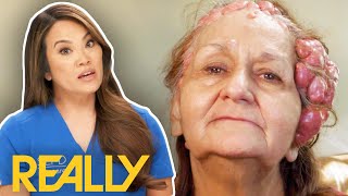 Dr Lee SHOCKED By Worst Case Of Cylindromas She's Ever Seen! | Dr Pimple Popper