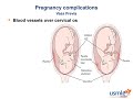 USMLE-Rx Express Video of the Week: Pregnancy Complications