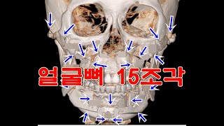 얼굴뼈15조각-양악수술+돌출입수술+광대수술+턱끝수술(심한 코골이 + 돌출입 치료 후기)[CBK성형외과_최봉균원장]顔の骨15切れ-両顎+セットバック+頬骨+顎先手術[チェ·ボンギュン院長]